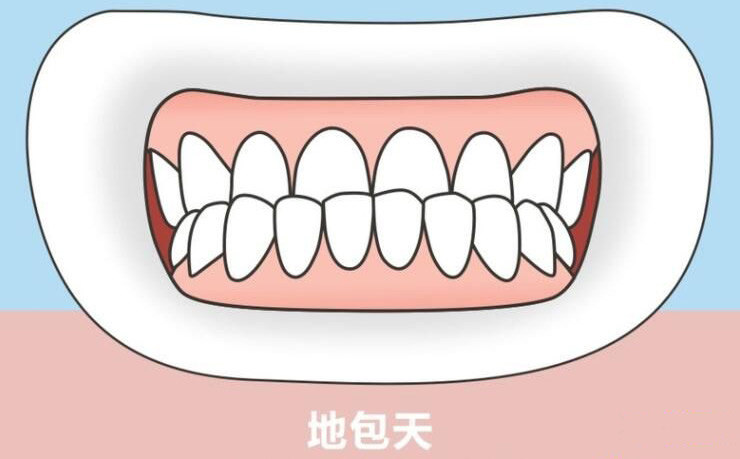 如果孩子有“地包天”，該怎么辦？